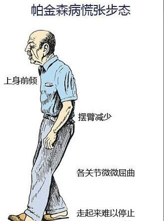 帕金森是遗传病吗 帕金森病会不会遗传