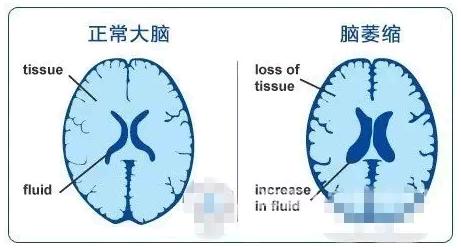 经颅磁治疗优势 老年人脑萎缩怎么引起来的