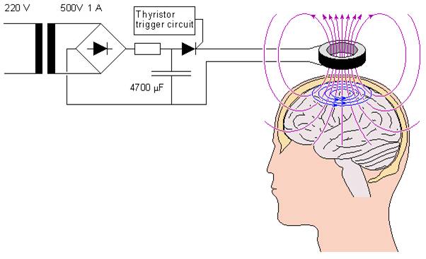 TMS(经颅磁刺激)