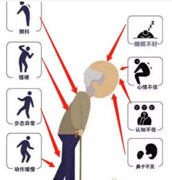 经颅磁刺激技术——帕金森病早期什么症状