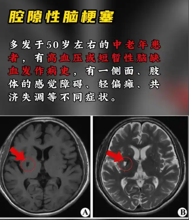 择思达斯家庭版经颅磁怎么样?腔梗严不严重